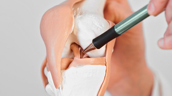 Anatomisches Kniegelenk veranschaulicht eine Kreuzbandoperation zur Wiederherstellung der Stabilität