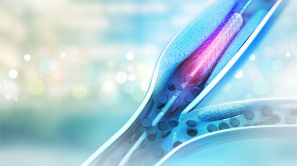 Modelldarstellung von einem Stent, welcher ein verengtes Blutgefäß weitet.