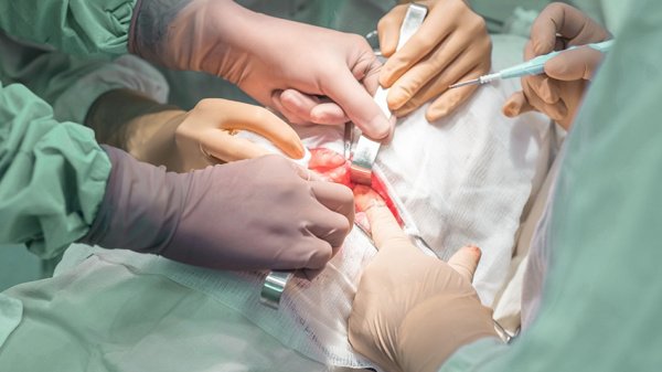 Operationsteam führt einen chirurgischen Eingriff am Pankreas unter sterilen Bedingungen durch.