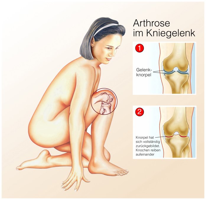 Darstellung einer knienden Frau: weitere Bilder zeigen Vergleich von gesundes Knie vs. erkranktes Knie mit fehlendem Knorpel