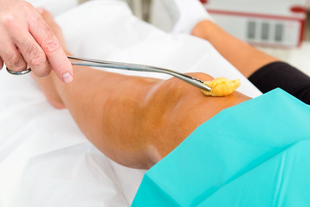 Therapeutische Behandlung des Knies nach einem Kniescheibenbruch zur Förderung der Heilung.