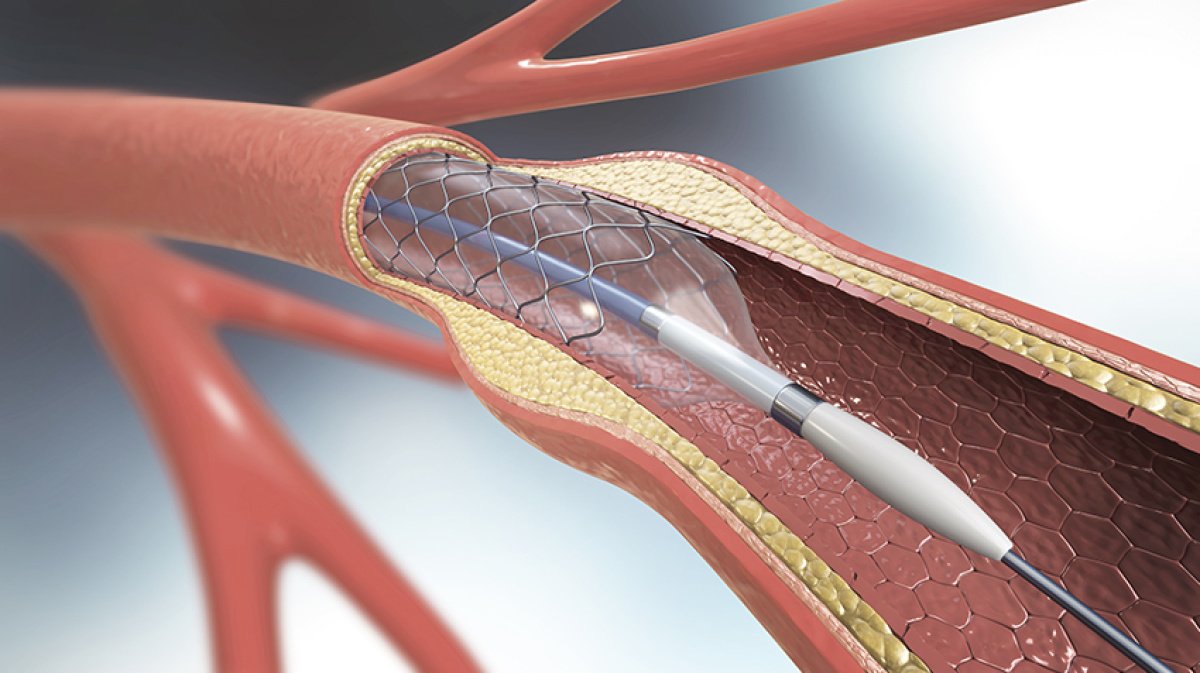 Medizinische Darstellung eines Stents zur Behandlung von Gefäßverengungen.
