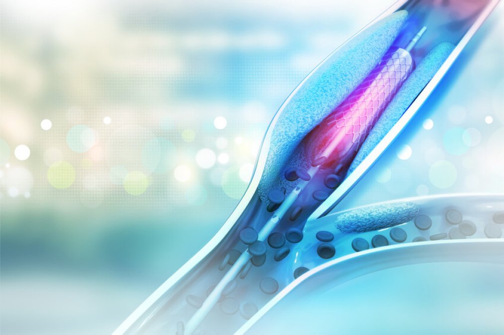 Modelldarstellung von einem Stent, welcher ein verengtes Blutgefäß weitet.